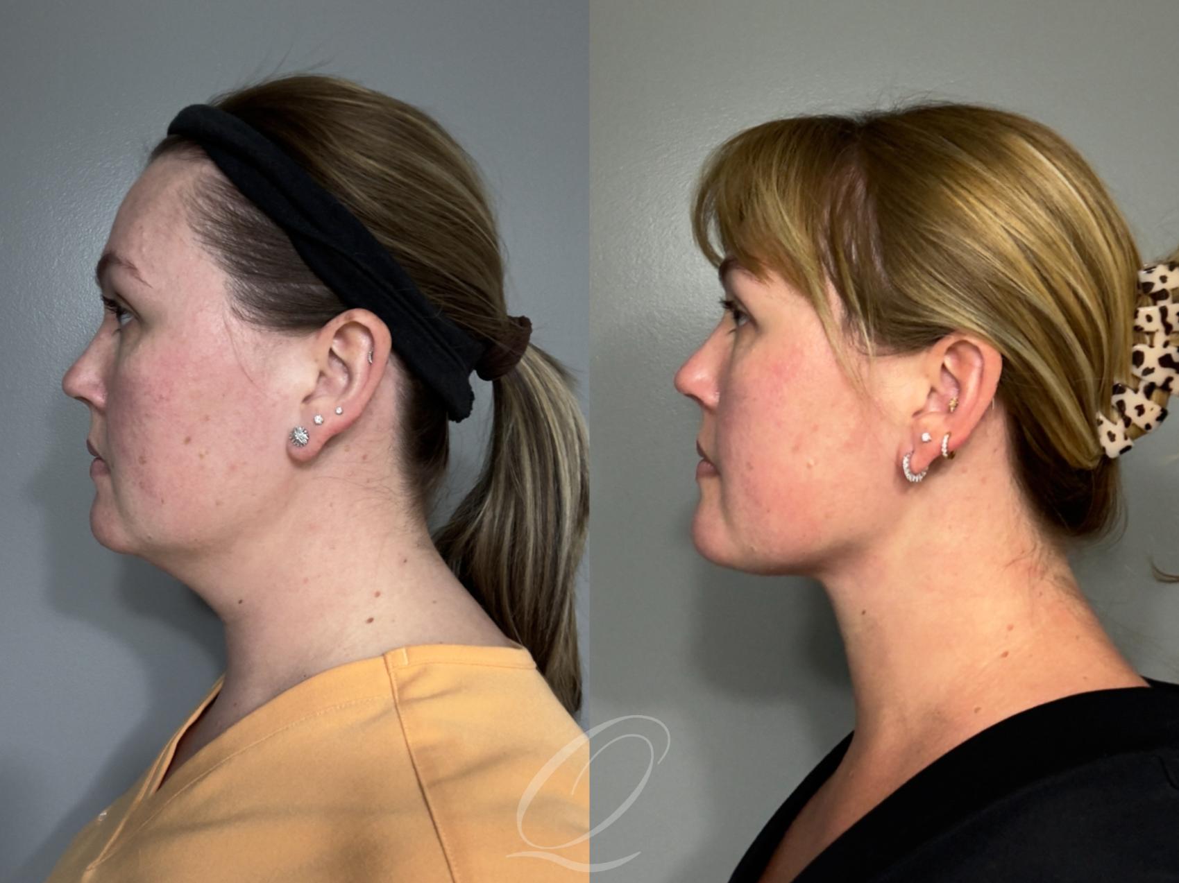 Deep Neck Contouring Case 1001992 Before & After Left Side | Serving Rochester, Syracuse & Buffalo, NY | Quatela Center for Plastic Surgery