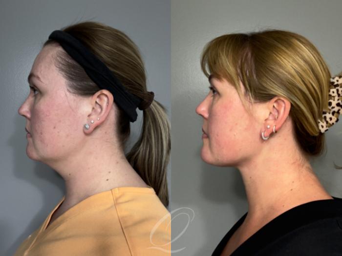 Deep Neck Contouring Case 1001992 Before & After Left Side | Serving Rochester, Syracuse & Buffalo, NY | Quatela Center for Plastic Surgery