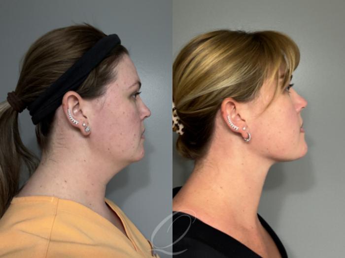 Deep Neck Contouring Case 1001992 Before & After Right Side | Serving Rochester, Syracuse & Buffalo, NY | Quatela Center for Plastic Surgery