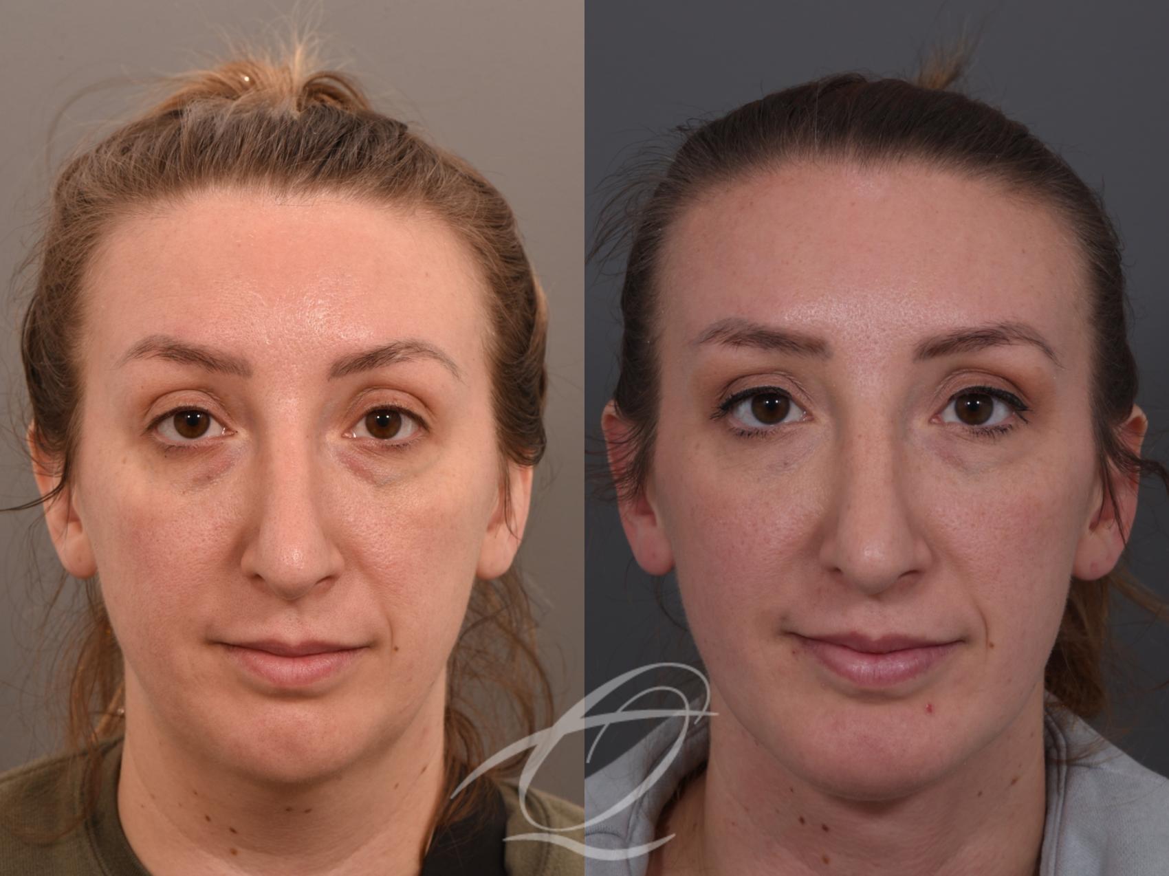 Deep Neck Contouring Case 1002062 Before & After Front | Serving Rochester, Syracuse & Buffalo, NY | Quatela Center for Plastic Surgery
