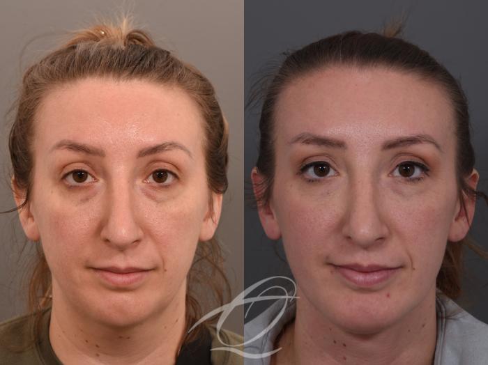Deep Neck Contouring Case 1002062 Before & After Front | Serving Rochester, Syracuse & Buffalo, NY | Quatela Center for Plastic Surgery