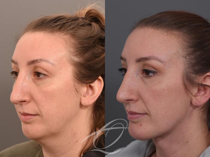 Deep Neck Contouring Case 1002062 Before & After Left Oblique | Serving Rochester, Syracuse & Buffalo, NY | Quatela Center for Plastic Surgery