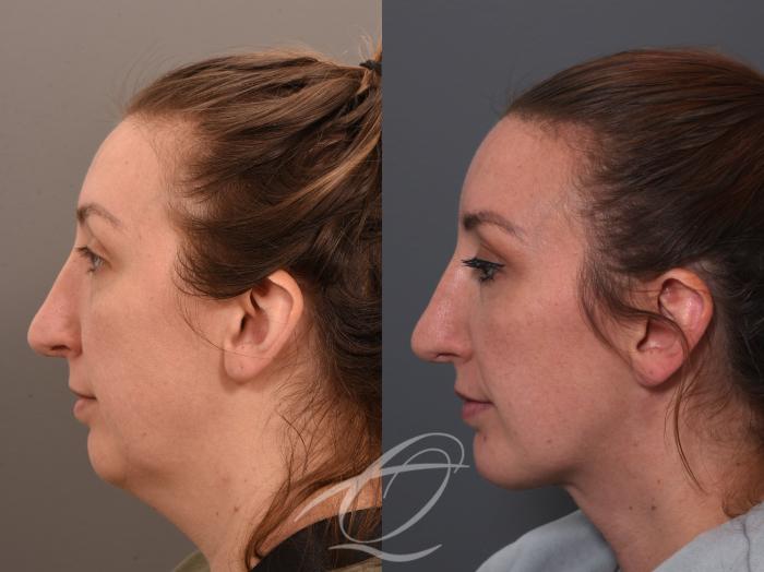 Deep Neck Contouring Case 1002062 Before & After Left Side | Serving Rochester, Syracuse & Buffalo, NY | Quatela Center for Plastic Surgery
