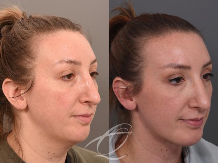 Deep Neck Contouring Case 1002062 Before & After Right Oblique | Serving Rochester, Syracuse & Buffalo, NY | Quatela Center for Plastic Surgery
