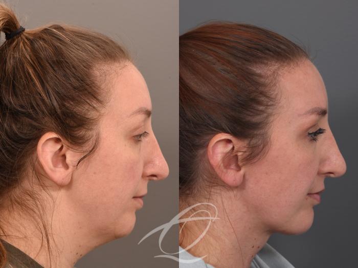 Deep Neck Contouring Case 1002062 Before & After Right Side | Serving Rochester, Syracuse & Buffalo, NY | Quatela Center for Plastic Surgery