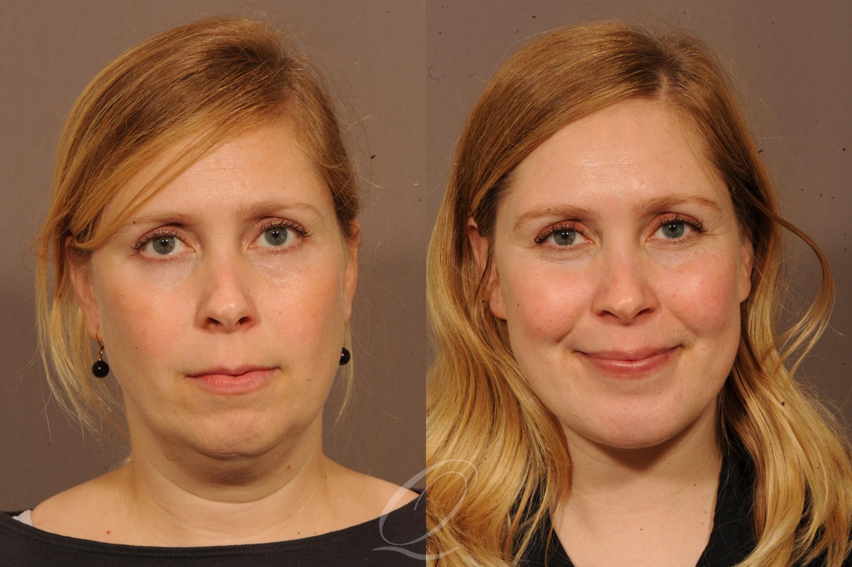 Chin Augmentation Case 1237 Before & After View #1 | Serving Rochester, Syracuse & Buffalo, NY | Quatela Center for Plastic Surgery
