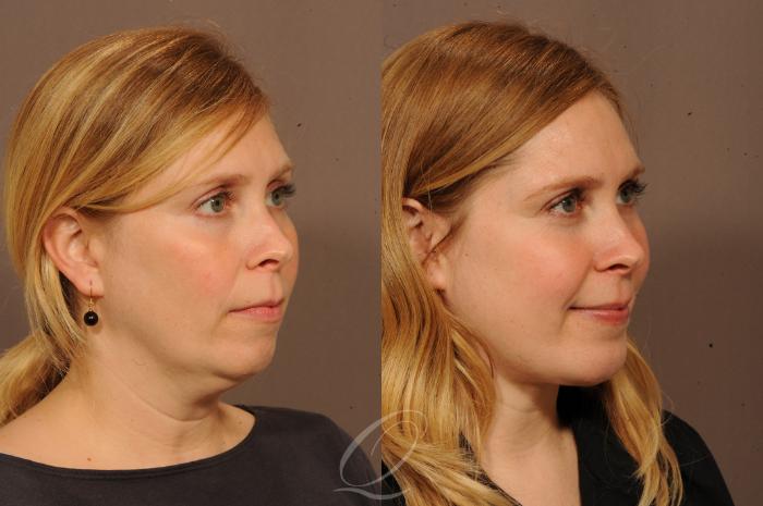 Deep Neck Contouring Case 1237 Before & After View #2 | Serving Rochester, Syracuse & Buffalo, NY | Quatela Center for Plastic Surgery