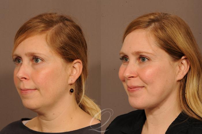 Chin Augmentation Case 1237 Before & After View #3 | Serving Rochester, Syracuse & Buffalo, NY | Quatela Center for Plastic Surgery