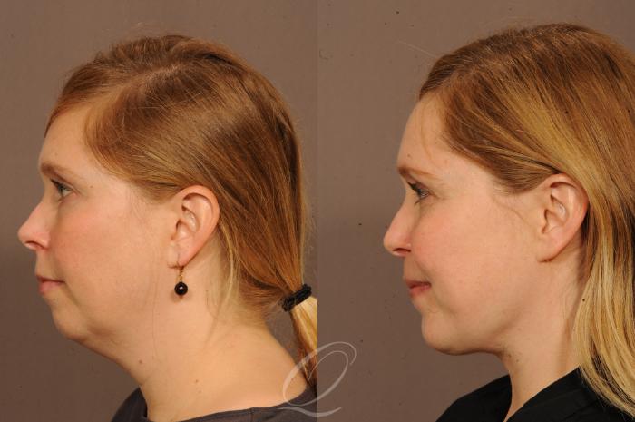 Deep Neck Contouring Case 1237 Before & After View #4 | Serving Rochester, Syracuse & Buffalo, NY | Quatela Center for Plastic Surgery
