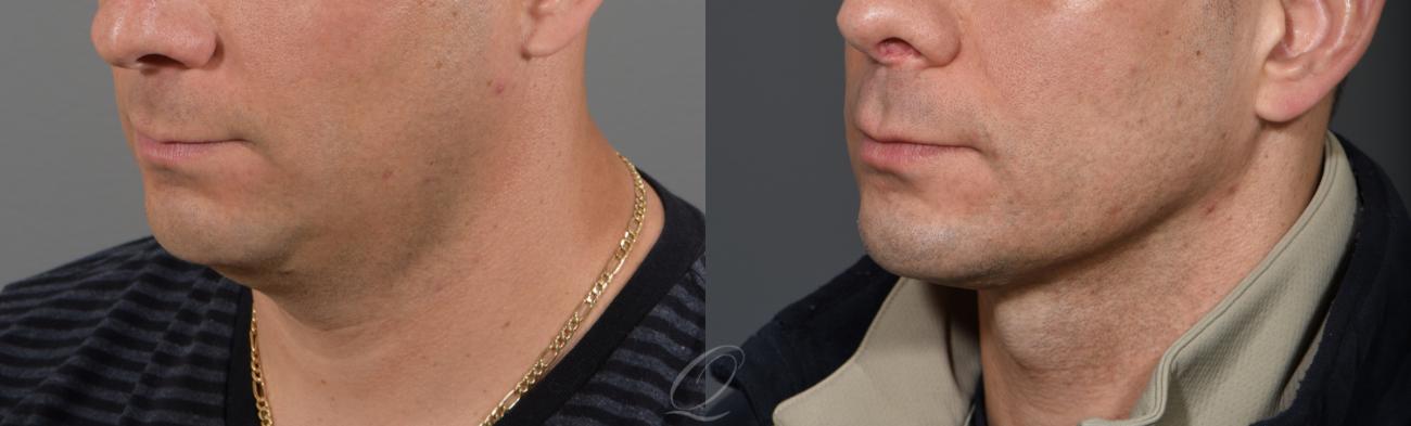 Deep Neck Contouring Case 1338 Before & After View #1 | Serving Rochester, Syracuse & Buffalo, NY | Quatela Center for Plastic Surgery