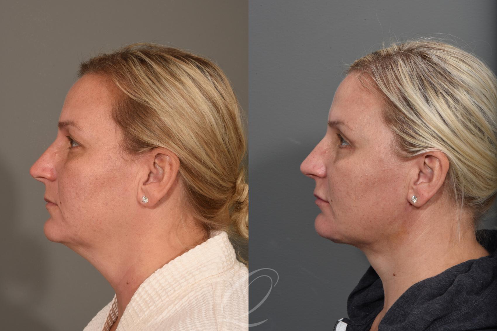 Deep Neck Contouring Case 1353 Before & After Left Side | Serving Rochester, Syracuse & Buffalo, NY | Quatela Center for Plastic Surgery