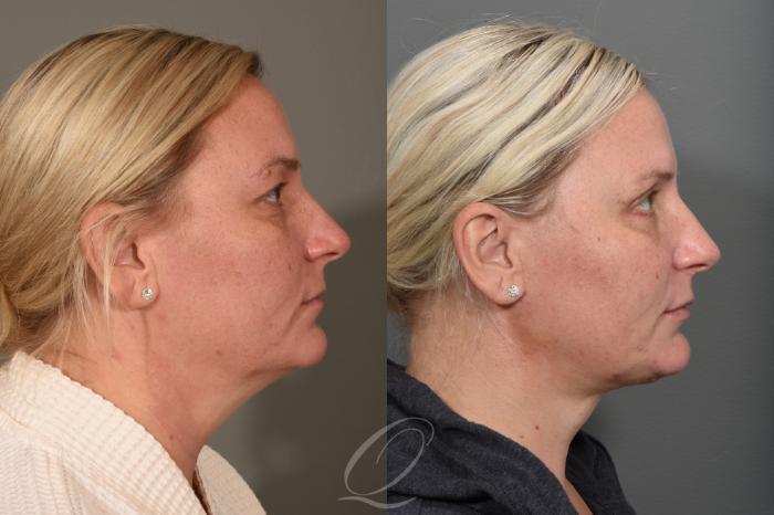 Deep Neck Contouring Case 1353 Before & After Right Side | Serving Rochester, Syracuse & Buffalo, NY | Quatela Center for Plastic Surgery