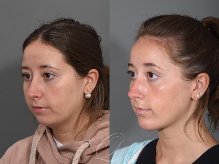 Deep Neck Contouring Case 1355 Before & After Left Oblique | Serving Rochester, Syracuse & Buffalo, NY | Quatela Center for Plastic Surgery