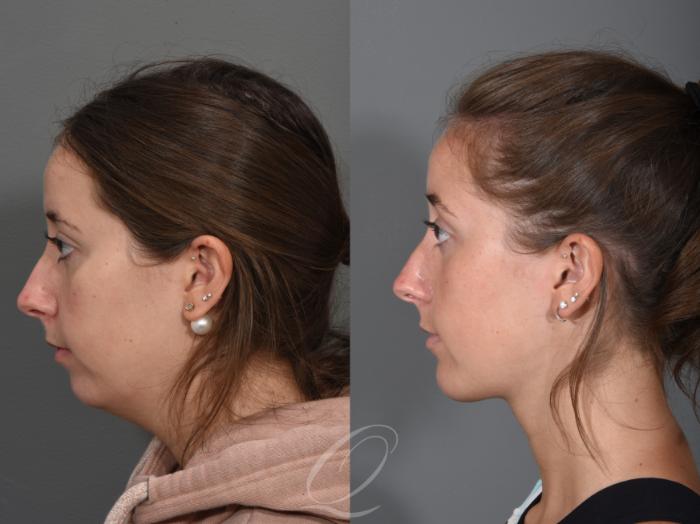 Deep Neck Contouring Case 1355 Before & After Left Side | Serving Rochester, Syracuse & Buffalo, NY | Quatela Center for Plastic Surgery