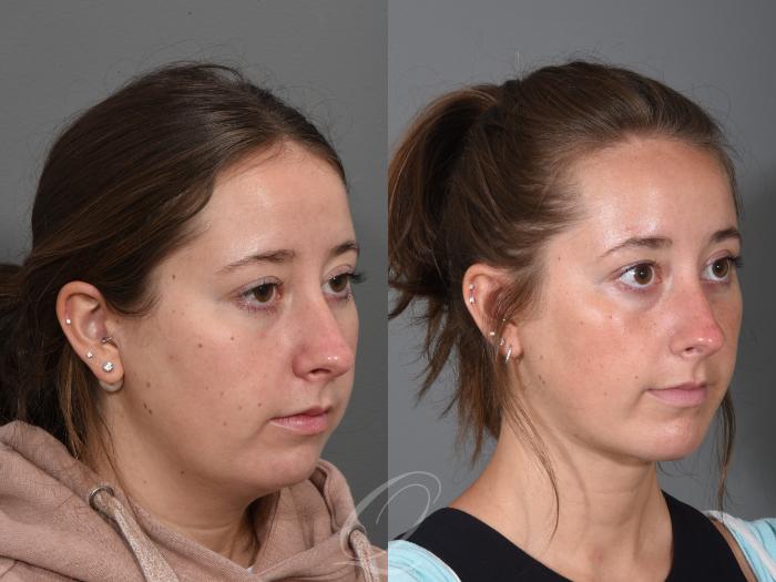 Deep Neck Contouring Case 1355 Before & After Right Oblique | Serving Rochester, Syracuse & Buffalo, NY | Quatela Center for Plastic Surgery