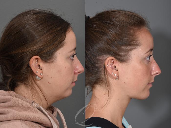 Deep Neck Contouring Case 1355 Before & After Right Side | Serving Rochester, Syracuse & Buffalo, NY | Quatela Center for Plastic Surgery