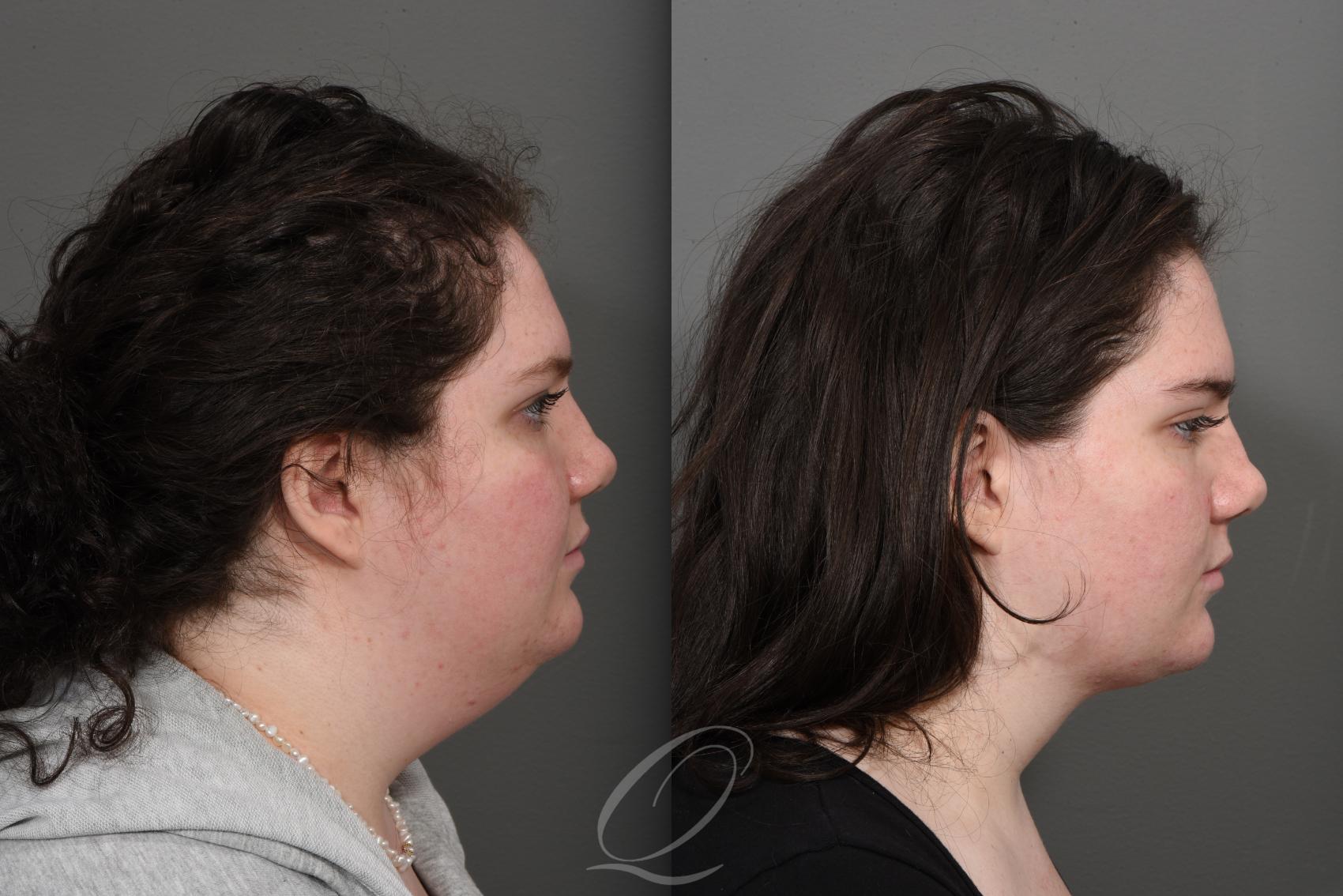 Deep Neck Contouring Case 1360 Before & After Right Side | Serving Rochester, Syracuse & Buffalo, NY | Quatela Center for Plastic Surgery
