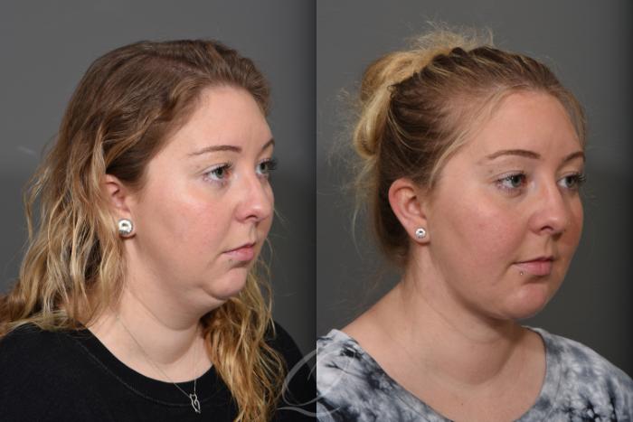 Deep Neck Contouring Case 1516 Before & After View #2 | Serving Rochester, Syracuse & Buffalo, NY | Quatela Center for Plastic Surgery