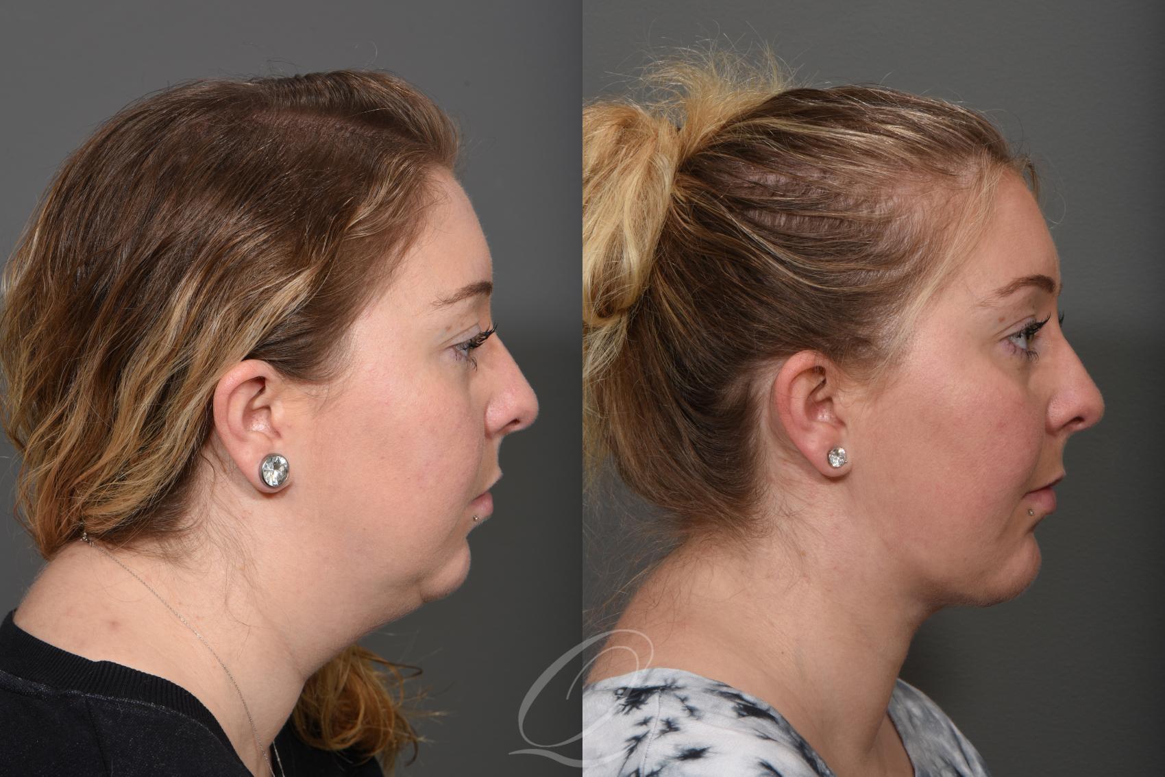 Deep Neck Contouring Case 1516 Before & After View #3 | Serving Rochester, Syracuse & Buffalo, NY | Quatela Center for Plastic Surgery