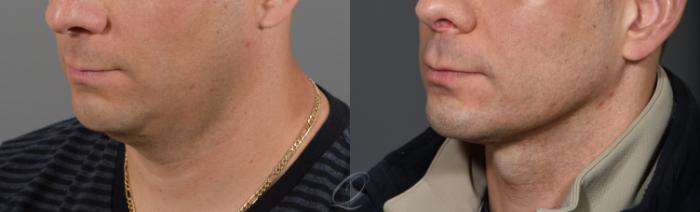 Deep Neck Contouring Case 323 Before & After View #1 | Serving Rochester, Syracuse & Buffalo, NY | Quatela Center for Plastic Surgery
