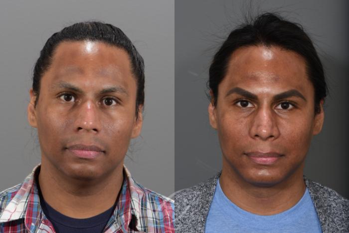 Deep Neck Contouring Case 338 Before & After View #1 | Serving Rochester, Syracuse & Buffalo, NY | Quatela Center for Plastic Surgery