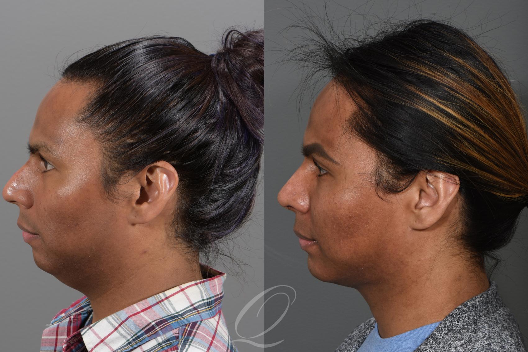 Deep Neck Contouring Case 338 Before & After View #4 | Serving Rochester, Syracuse & Buffalo, NY | Quatela Center for Plastic Surgery
