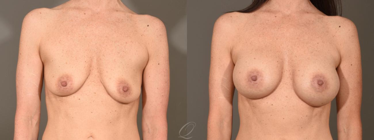 Dual Plane Breast Augmentation Case 379 Before & After View #1 | Serving Rochester, Syracuse & Buffalo, NY | Quatela Center for Plastic Surgery
