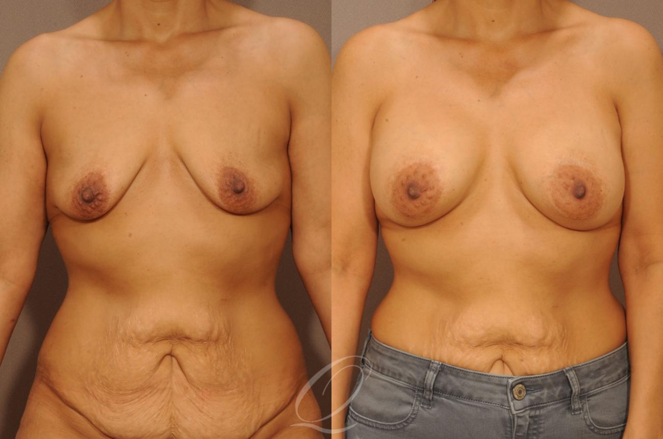 Dual Plane Breast Augmentation Case 277 Before & After View #1 | Serving Rochester, Syracuse & Buffalo, NY | Quatela Center for Plastic Surgery
