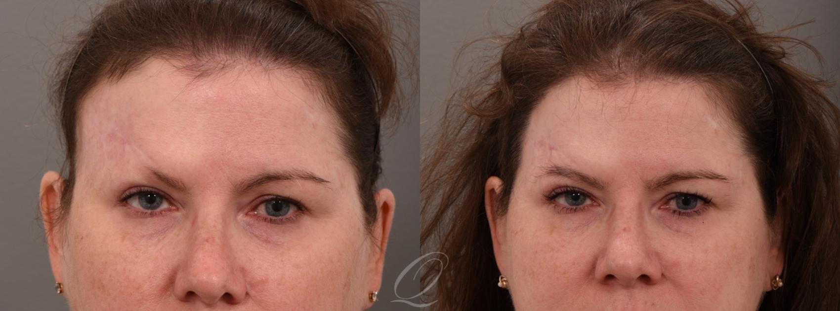 Female FUT Hair Transplant Case 1001576 Before & After Front | Serving Rochester, Syracuse & Buffalo, NY | Quatela Center for Plastic Surgery