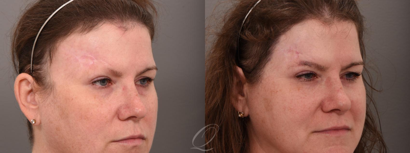 Female FUT Hair Transplant Case 1001576 Before & After Right Oblique | Serving Rochester, Syracuse & Buffalo, NY | Quatela Center for Plastic Surgery