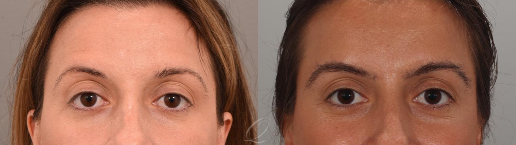 Eyebrow Hair Transplant Case 1001894 Before & After Front | Serving Rochester, Syracuse & Buffalo, NY | Quatela Center for Plastic Surgery
