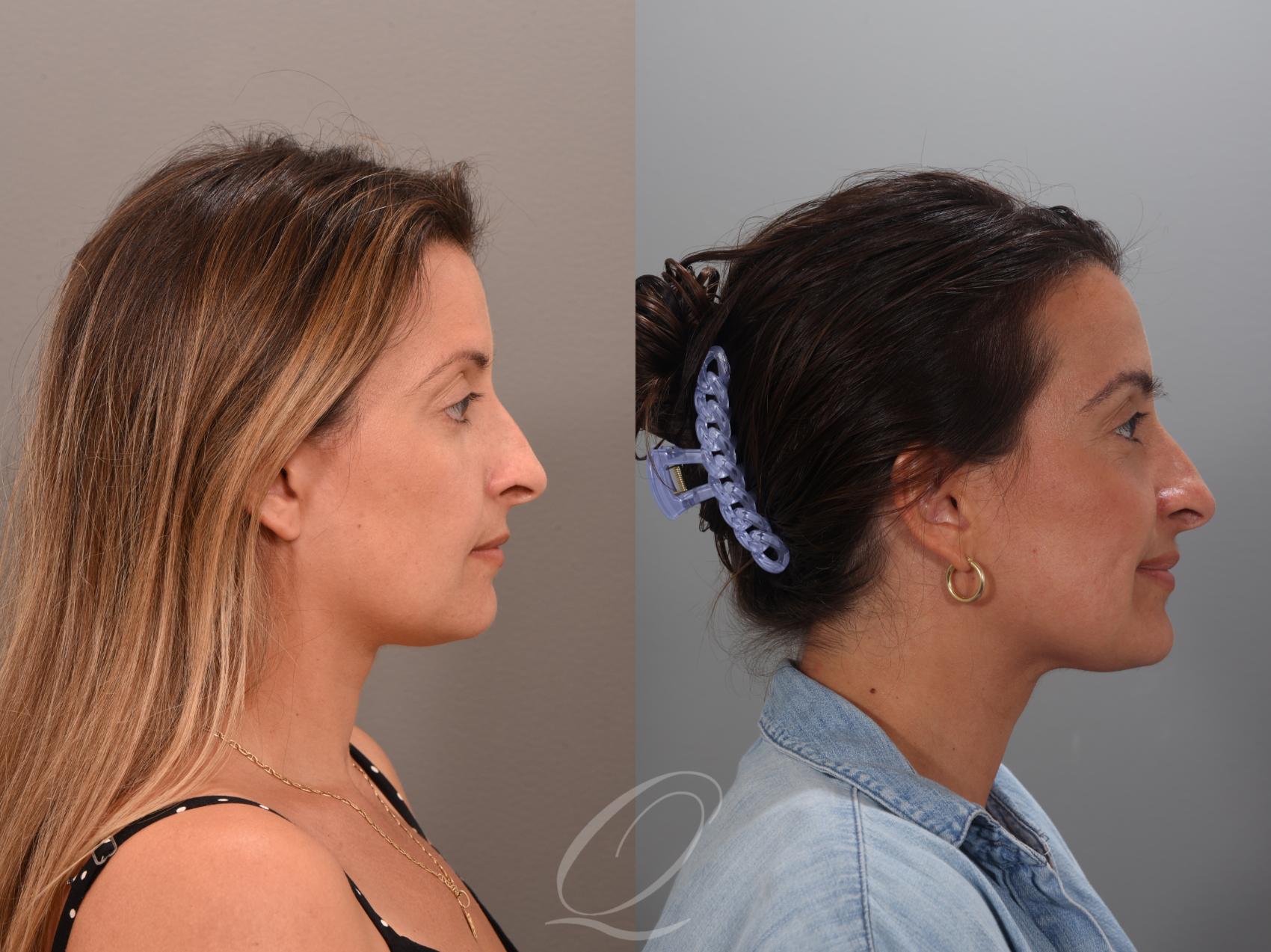 Eyebrow Hair Transplant Case 1001894 Before & After Left Oblique | Serving Rochester, Syracuse & Buffalo, NY | Quatela Center for Plastic Surgery