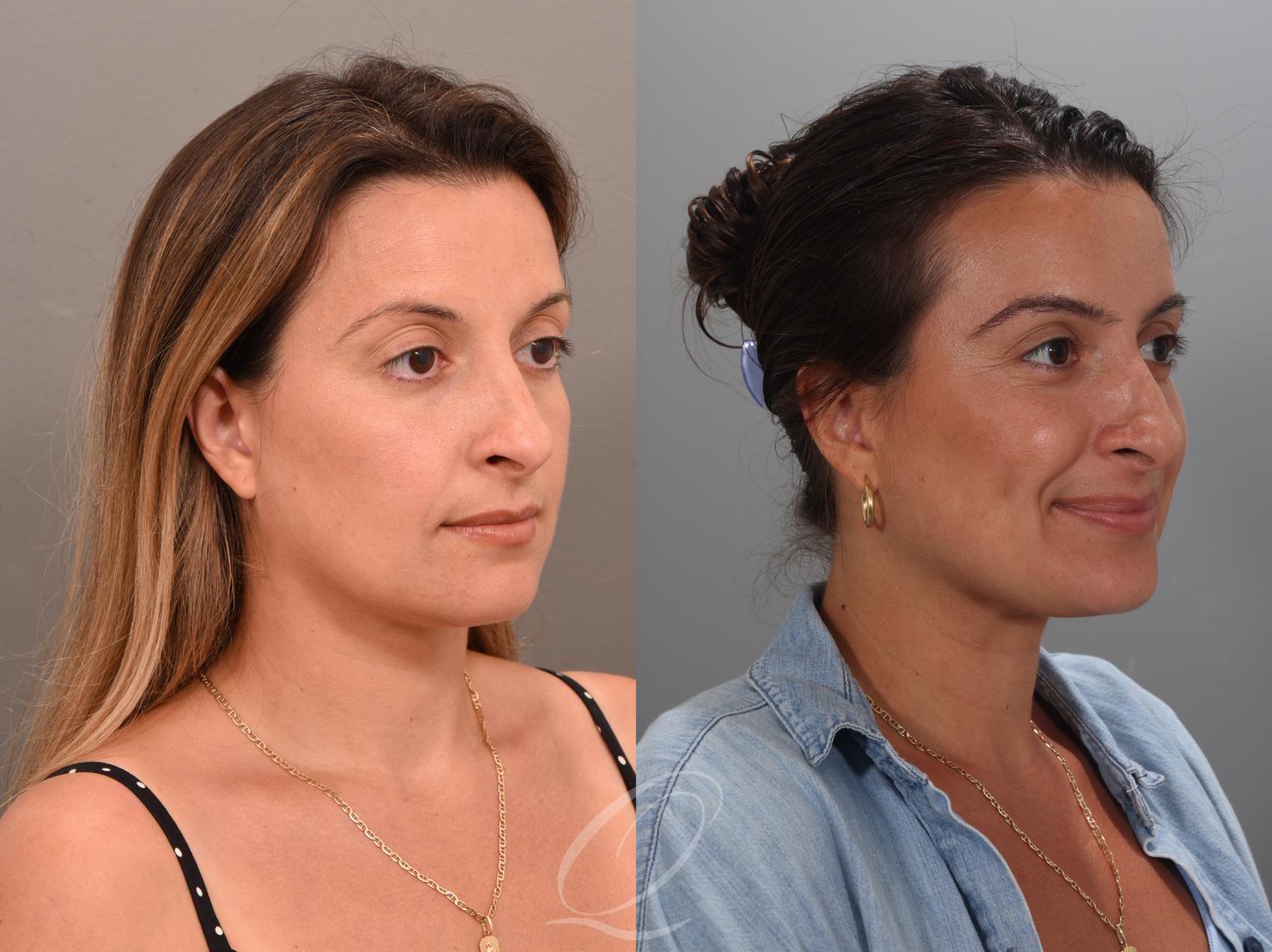 Eyebrow Hair Transplant Case 1001894 Before & After Left Side | Serving Rochester, Syracuse & Buffalo, NY | Quatela Center for Plastic Surgery