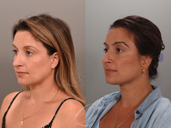 Eyebrow Hair Transplant Case 1001894 Before & After Right Side | Serving Rochester, Syracuse & Buffalo, NY | Quatela Center for Plastic Surgery