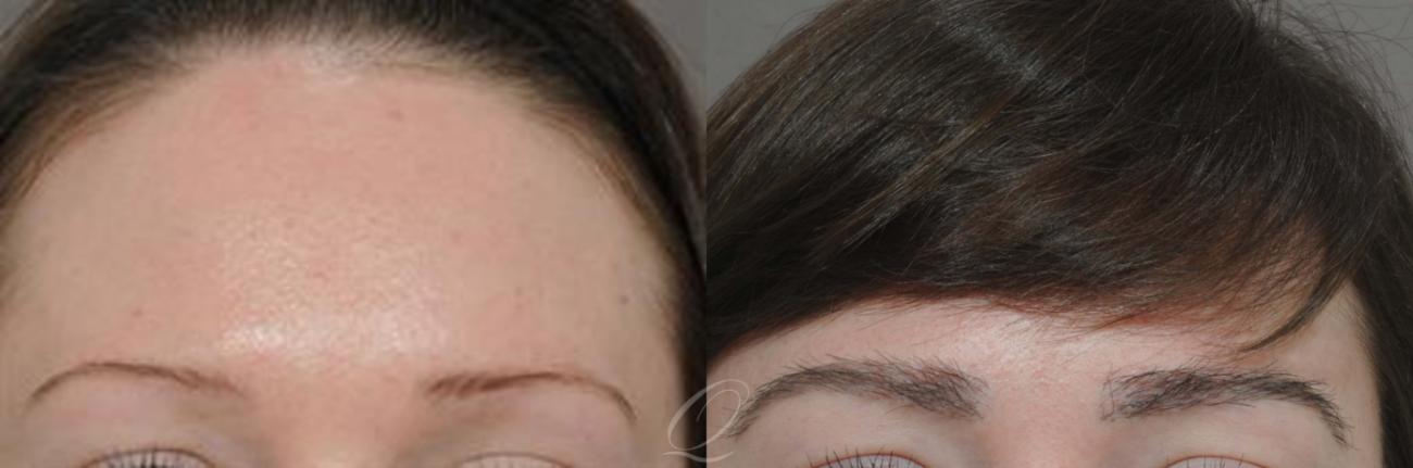 Eyebrow Hair Transplant Before & After Photos Patient 1051 | Rochester,  Buffalo, & Syracuse, NY | Quatela Center for Hair Restoration