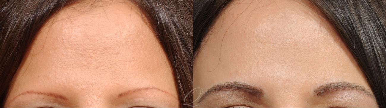 Eyebrow Hair Transplant Case 1052 Before & After View #1 | Serving Rochester, Syracuse & Buffalo, NY | Quatela Center for Plastic Surgery