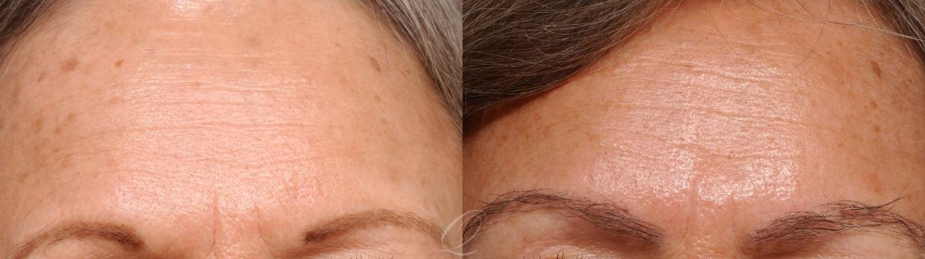 Eyebrow Hair Transplant Case 1054 Before & After View #1 | Serving Rochester, Syracuse & Buffalo, NY | Quatela Center for Plastic Surgery