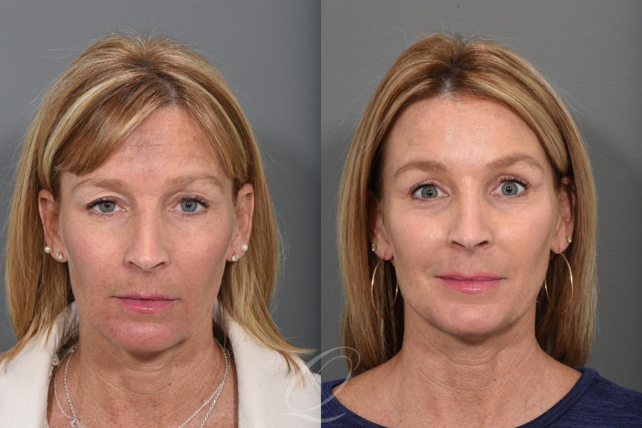 Eyelid Lift Case 1369 Before & After Front | Serving Rochester, Syracuse & Buffalo, NY | Quatela Center for Plastic Surgery