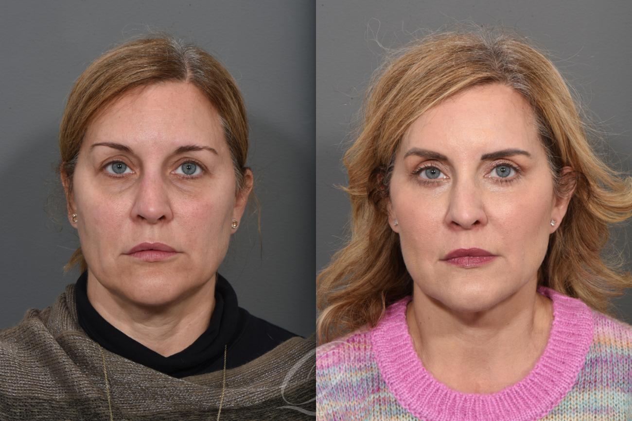 Eyelid Lift Case 1405 Before & After Front | Serving Rochester, Syracuse & Buffalo, NY | Quatela Center for Plastic Surgery