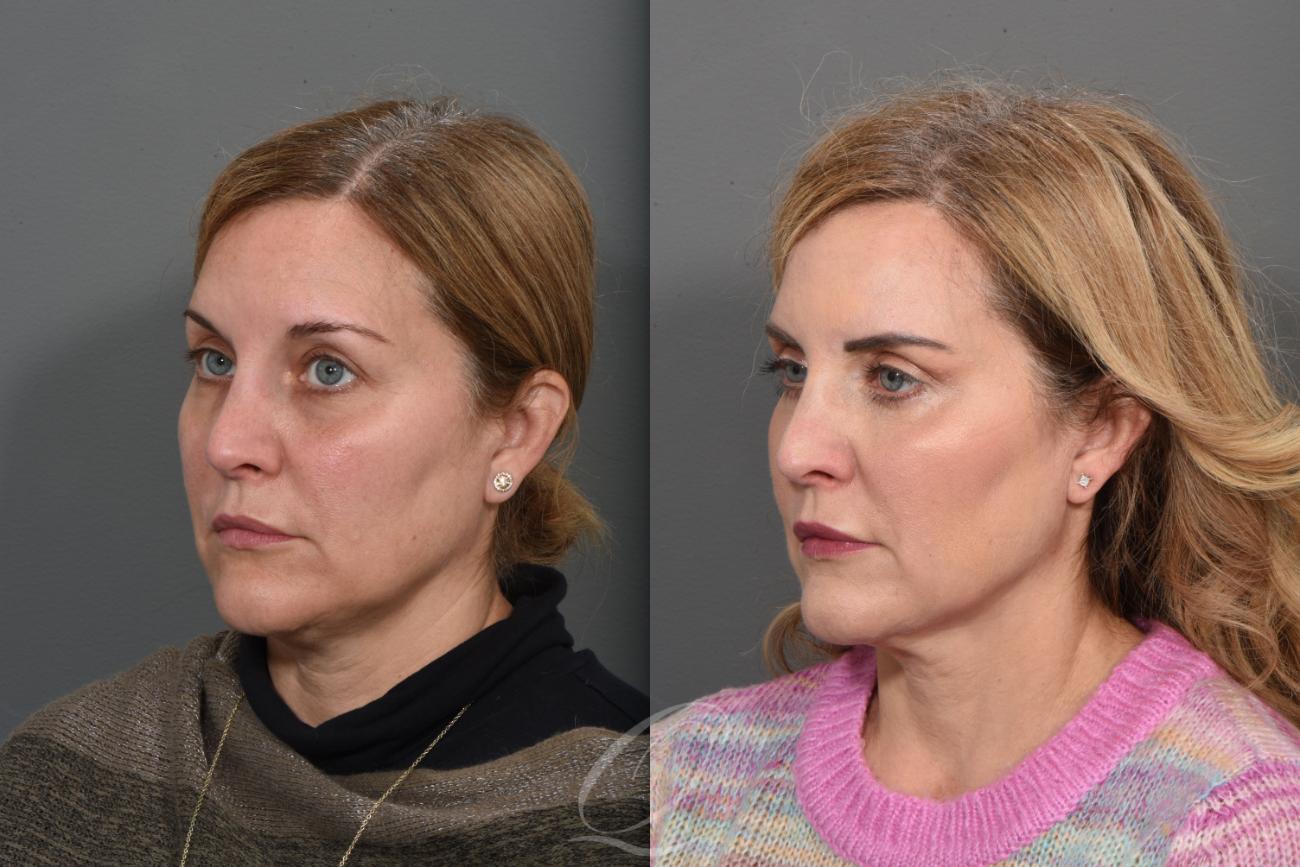 Eyelid Lift Case 1405 Before & After Left Oblique | Serving Rochester, Syracuse & Buffalo, NY | Quatela Center for Plastic Surgery
