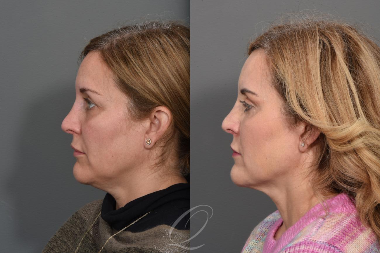 Skin Resurfacing Case 1405 Before & After Left Side | Serving Rochester, Syracuse & Buffalo, NY | Quatela Center for Plastic Surgery