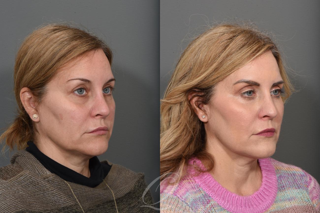 Eyelid Lift Case 1405 Before & After Right Oblique | Serving Rochester, Syracuse & Buffalo, NY | Quatela Center for Plastic Surgery