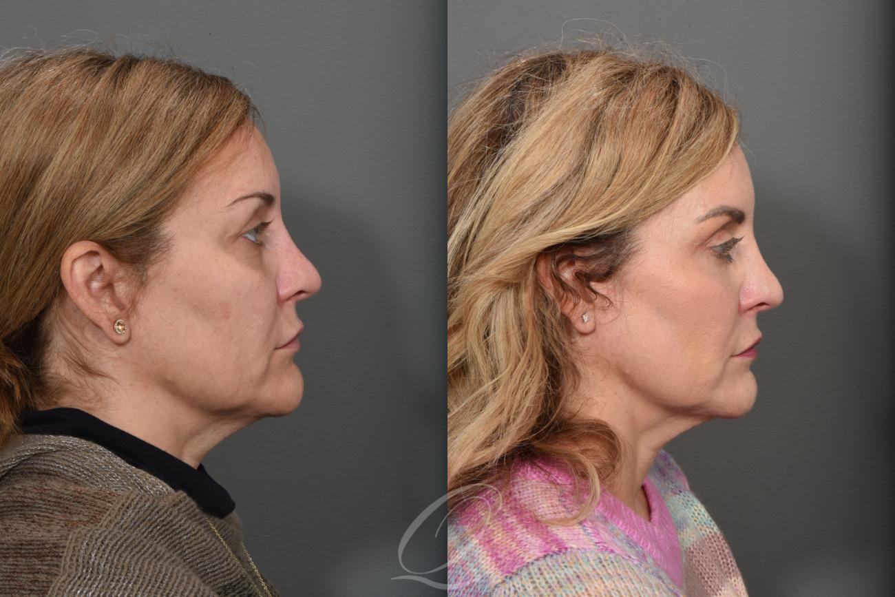 Eyelid Lift Case 1405 Before & After Right Side | Serving Rochester, Syracuse & Buffalo, NY | Quatela Center for Plastic Surgery