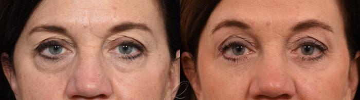 Eyelid Lift Case 1001554 Before & After Close Up | Serving Rochester, Syracuse & Buffalo, NY | Quatela Center for Plastic Surgery