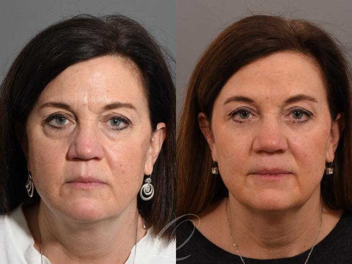 Eyelid Lift Case 1001554 Before & After Front | Serving Rochester, Syracuse & Buffalo, NY | Quatela Center for Plastic Surgery