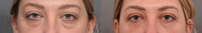 Eyelid Lift Case 1001569 Before & After Front Close-Up | Serving Rochester, Syracuse & Buffalo, NY | Quatela Center for Plastic Surgery