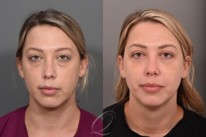 Eyelid Lift Case 1001569 Before & After Front | Serving Rochester, Syracuse & Buffalo, NY | Quatela Center for Plastic Surgery