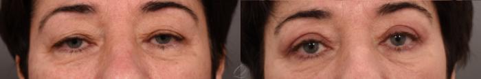 Eyelid Lift Case 1001570 Before & After Front Close-Up | Serving Rochester, Syracuse & Buffalo, NY | Quatela Center for Plastic Surgery