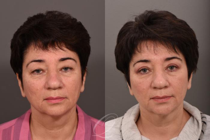Eyelid Lift Case 1001570 Before & After Front | Serving Rochester, Syracuse & Buffalo, NY | Quatela Center for Plastic Surgery