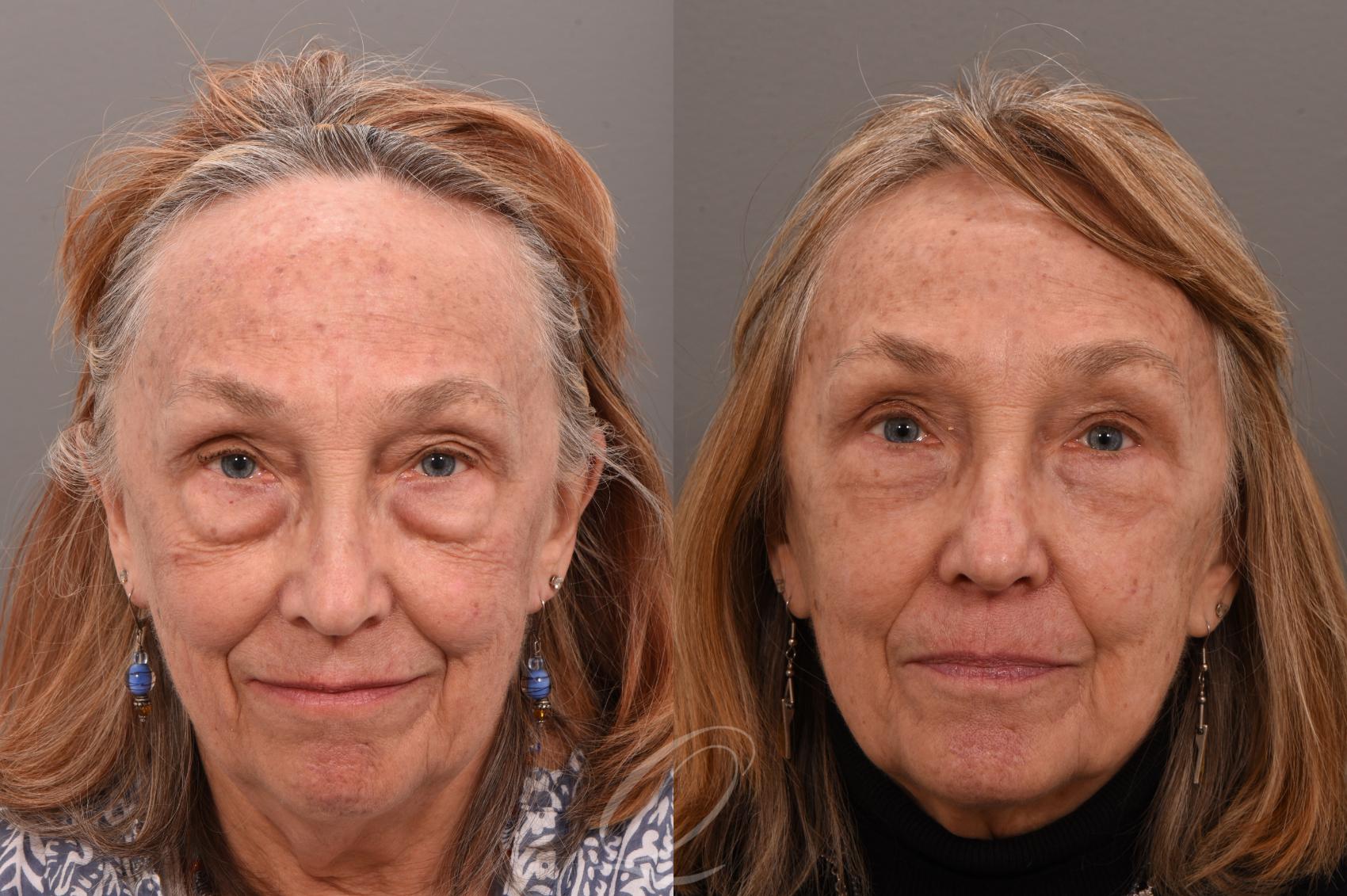 Eyelid Lift Case 1001595 Before & After Front | Serving Rochester, Syracuse & Buffalo, NY | Quatela Center for Plastic Surgery